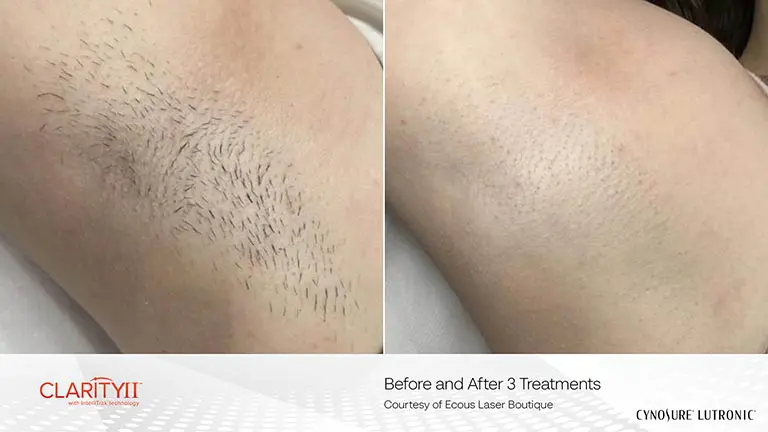 AMP-1532-Clarity-II-BNA-Underarm
