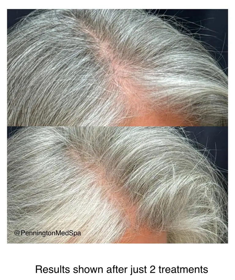 Hair-Resortation-with-The-Lutronic-Ultra-Laser